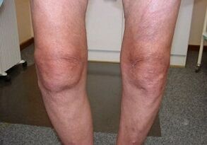 How to treat the osteoarthritis of the knee joint