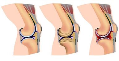 Stages of Development of the osteoarthritis of the knee joint