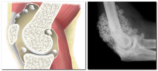 Chondromatosis with pain in the hip joint.