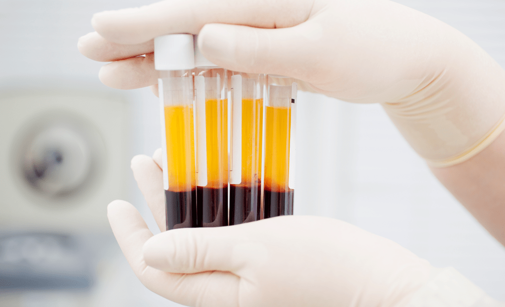 Platelet-rich plasma for PRP therapy in osteoarthritis
